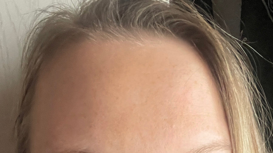 Koža po uporabi obližev LUMINE