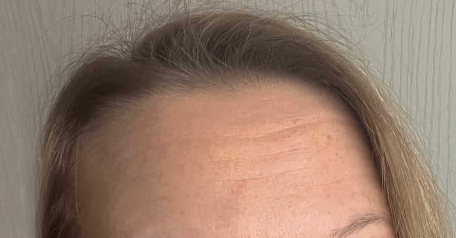 Koža pred uporabo obližev LUMINE